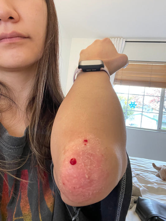 Hydrocolloid Bandages for Eczema-Prone Skin: Gentle, Soothing Protection When You Need It Most