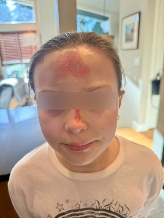 Hydrocolloid Mythbusters: 7 Common Misconceptions About Modern Wound Healing—Debunked