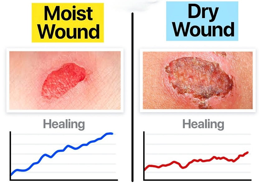 Moist Wound Healing vs. Dry Healing: An Evidence-Based Comparison