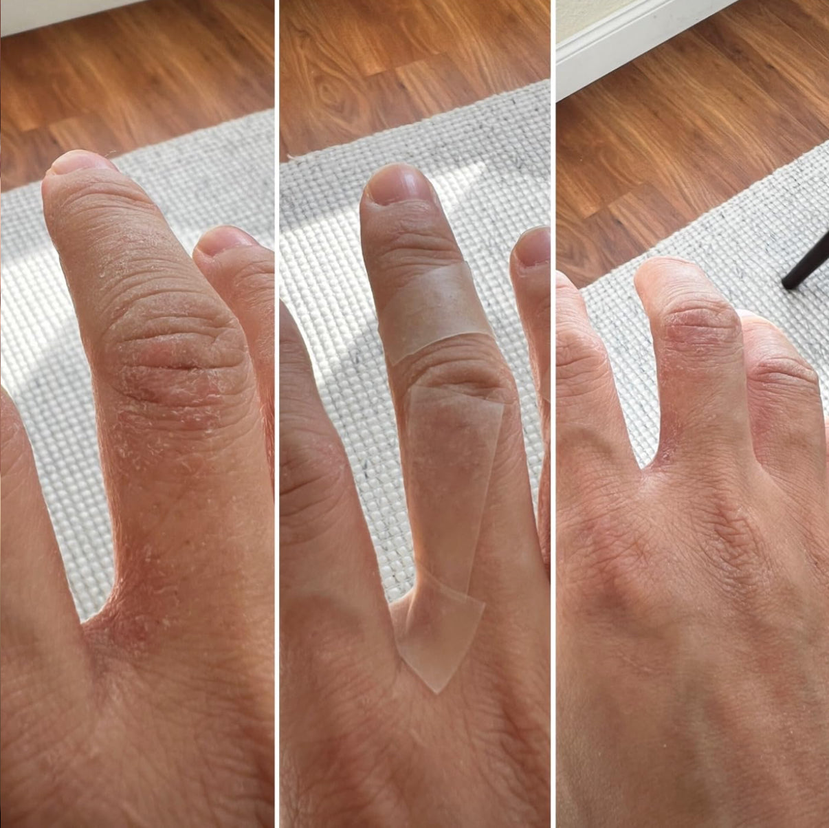 Hand eczema 3-panel: cracked dry skin, SUPERBAND applied, smooth healed skin