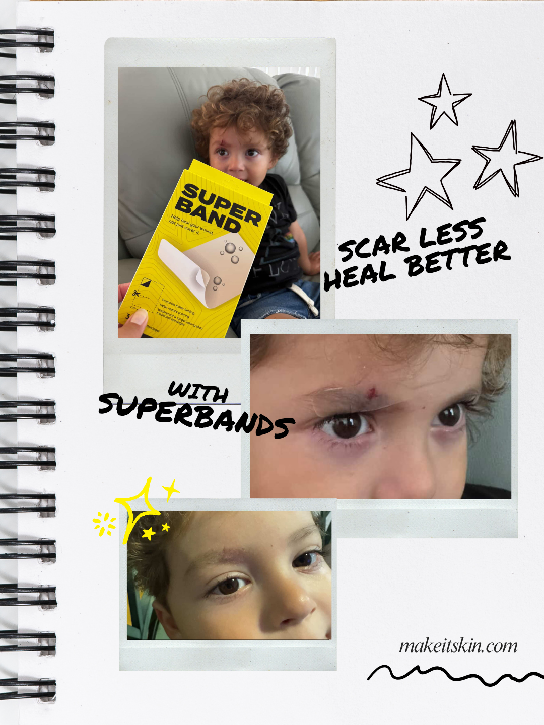 Toddler eyebrow cut before and after SUPERBAND — scar less, heal better