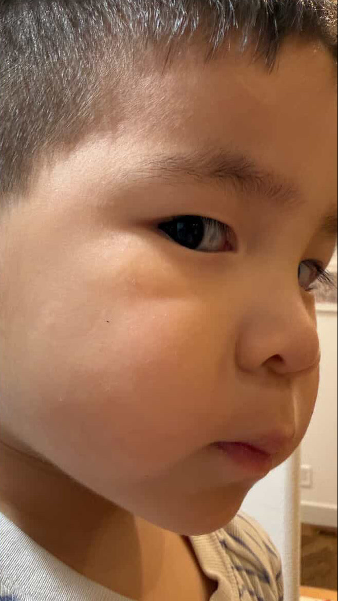 After 4 days with SUPERBAND: healed skin, no visible scar