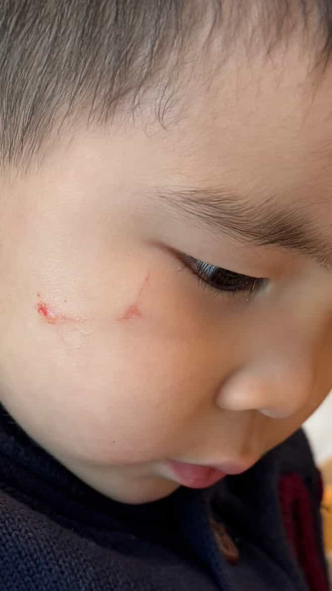 Before: Fresh bite mark on child's face