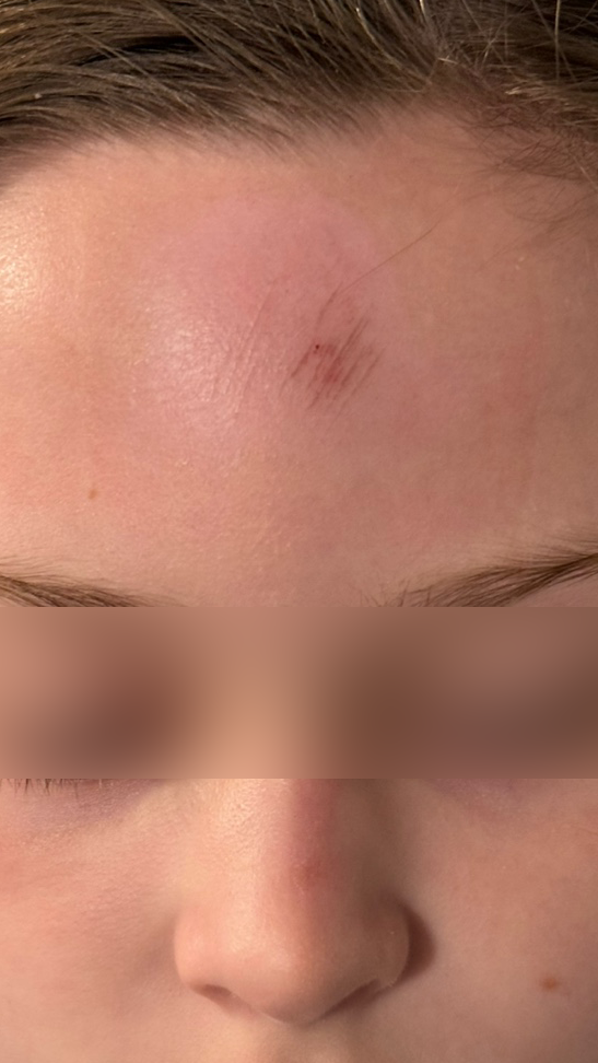 After healing: only faint marks remain